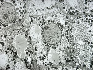 F,1y. | glycogenosis type II. (glycogen dissolved due to UA blockstaining) F,1y. | glycogenosis type II. (glycogen dissolved due to UA blockstaining)